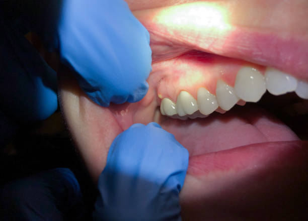 Best Emergency Dental Care for Sports Injuries in Radford, VA