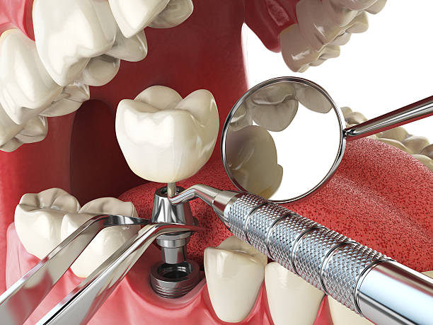 Best Emergency Treatment for Oral Infections in Radford, VA